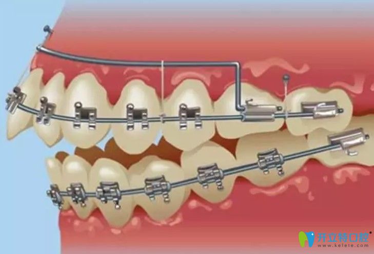 德國(guó)非凡自鎖托槽圖片