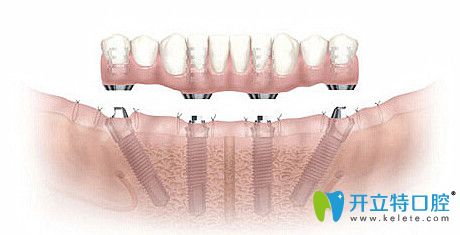 牙齒缺失帶來的三大危害