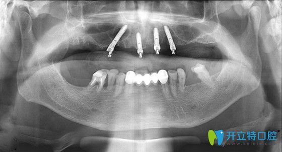 張大爺在東營鉑爾口腔做種植牙后的CT片