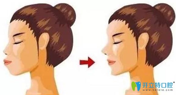 戴牙套嘴巴會(huì)變凸?武漢仁愛口腔隱形牙套矯正案例來澄清