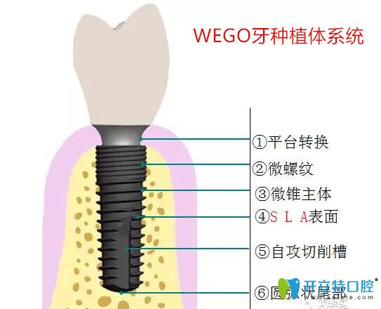 威高種植體特點(diǎn)