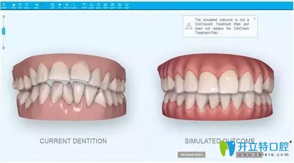 隱適美口掃儀掃描效果顯示圖