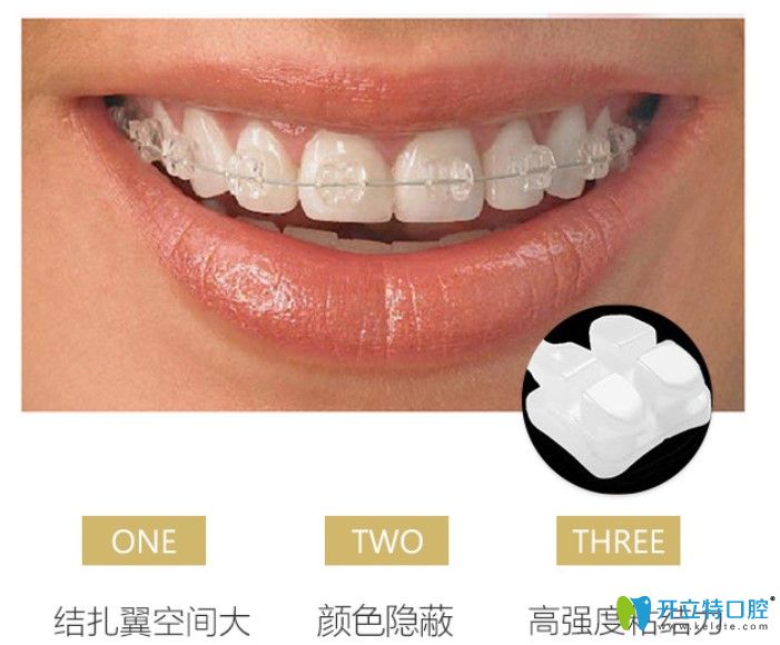 廣州壹加壹口腔陶瓷半隱形牙齒矯正價格