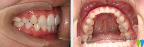 成都圣貝牙科正畸如何？附網(wǎng)友整牙的感受及圣貝箍牙價(jià)格