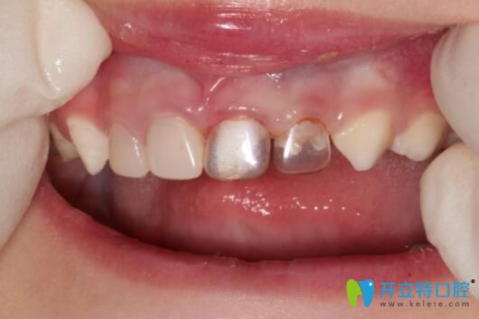 透明預(yù)成冠