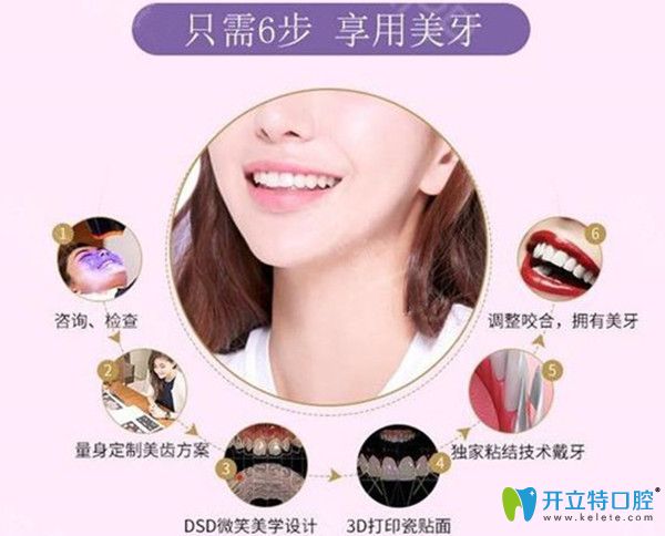 牙貼面的過程