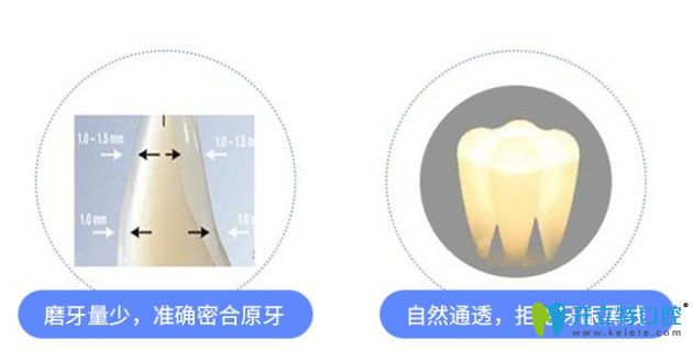 國產(chǎn)全瓷牙好還是進口好