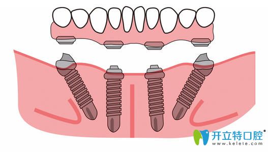 all-on-4速導(dǎo)種植牙技術(shù)