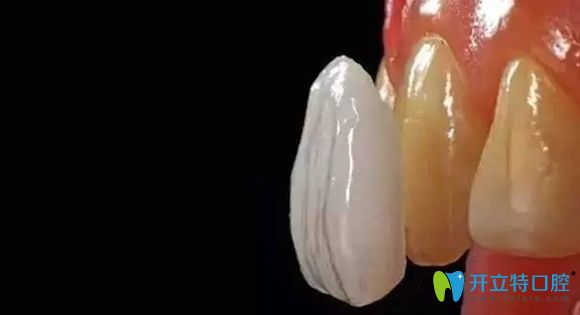 牙齒貼面修復(fù)為現(xiàn)在色素牙或缺損牙修復(fù)的較好方法