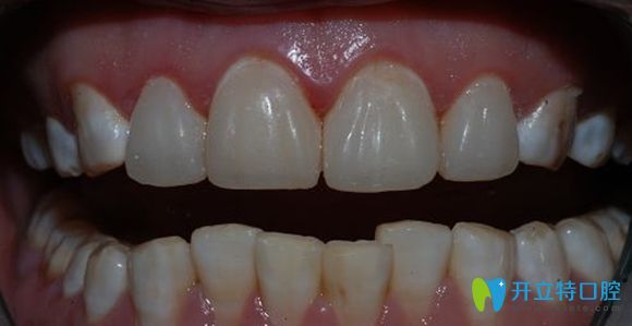 樹(shù)脂牙齒貼面修復(fù)效果圖