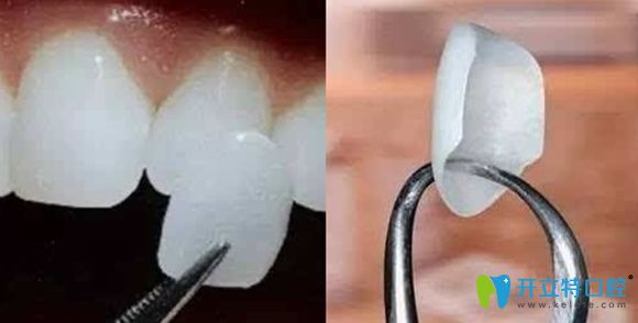 牙齒貼面多少錢(qián)一顆的價(jià)格展示