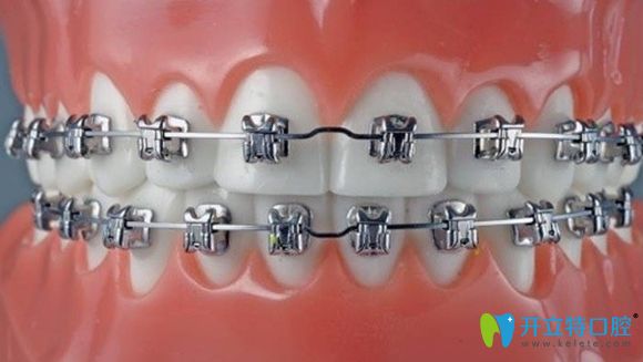 從適應(yīng)范圍和經(jīng)濟方面比較，固定矯治要比隱形矯治略勝一籌
