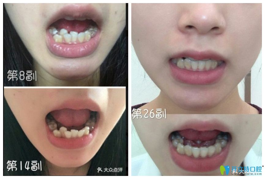 在美萊口腔做時(shí)代天使隱形矯正對(duì)比圖