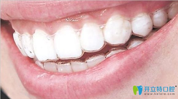 隱形矯正和固定矯正哪個好呢