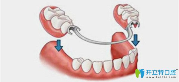 鑲牙的種類以及鑲牙的費用