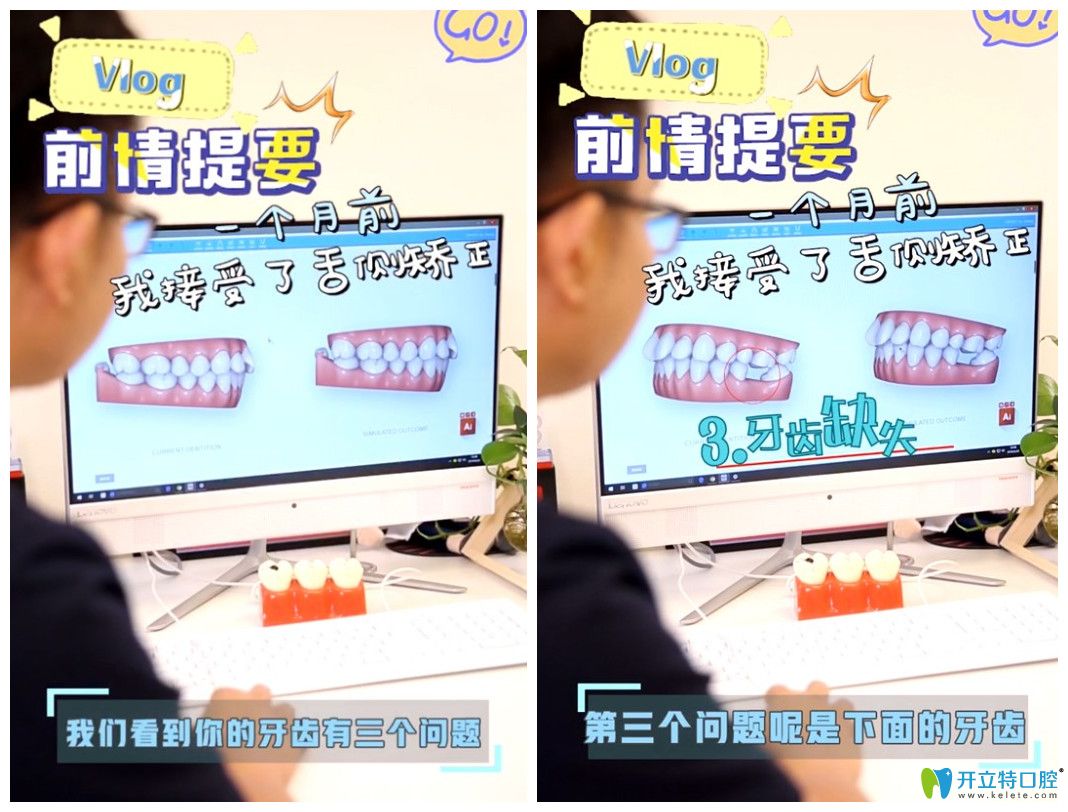 來(lái)看找上海維樂(lè)口腔楊國(guó)平做舌側(cè)矯正的人是怎么評(píng)價(jià)他的