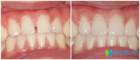 北京佳美口腔牙齒貼面修復(fù)效果圖