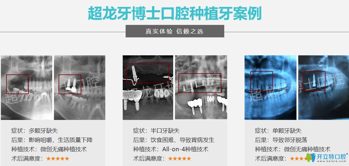 長(zhǎng)春超龍牙博士口腔種植牙案例 長(zhǎng)春超龍牙博士口腔種植牙案例