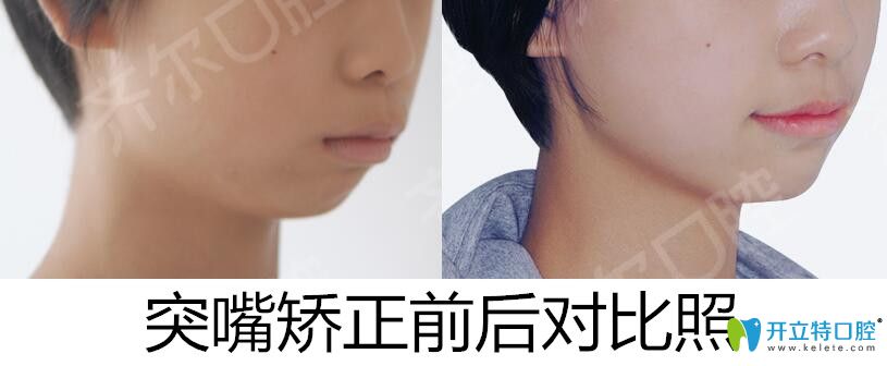 杭州齊爾口腔齙牙矯正前后對(duì)比照
