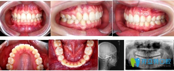 小哥哥在北京佳美口腔正畸牙齒術(shù)后圖
