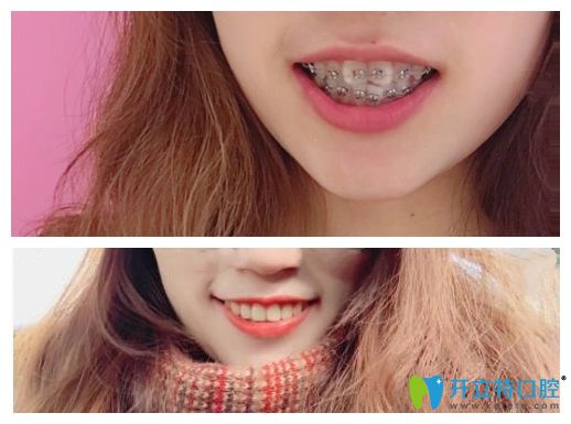 在曙光口腔牙齒矯正前后對(duì)比圖