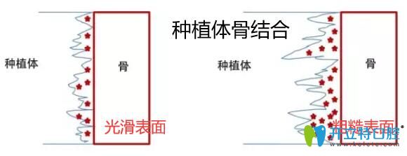 種植體與骨結(jié)合