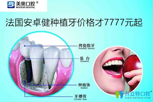 忒狠！聽說上海美奧口腔法國安卓健種植牙價格7777元起