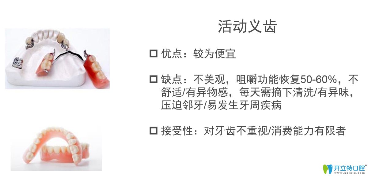 活動(dòng)假牙優(yōu)缺點(diǎn)