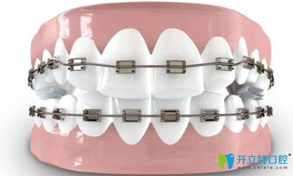 金屬托槽矯正是目前被廣泛使用的經(jīng)典矯正方式