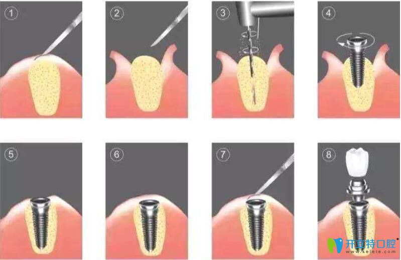 想知道種植牙微創(chuàng)和普通區(qū)別,先了解下不開瓣3d導板種植牙