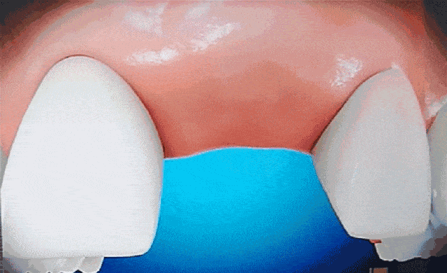 微創(chuàng)種植牙過(guò)程