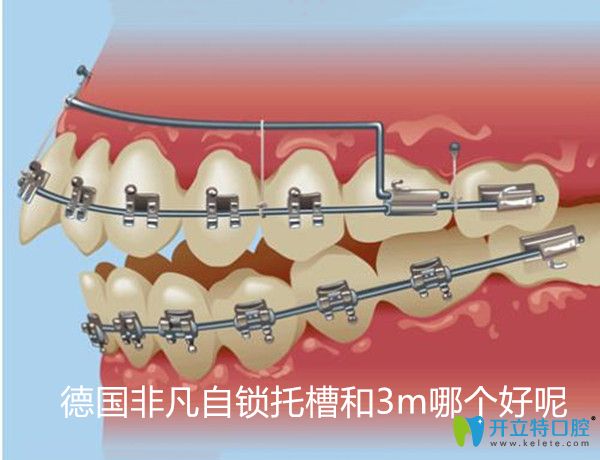 自鎖托槽矯正圖示