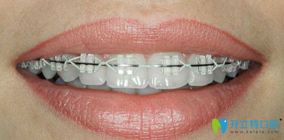 陶瓷半隱形托槽矯正效果圖