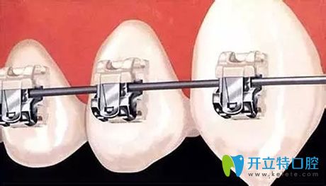 牙齒自鎖托槽矯正詳圖