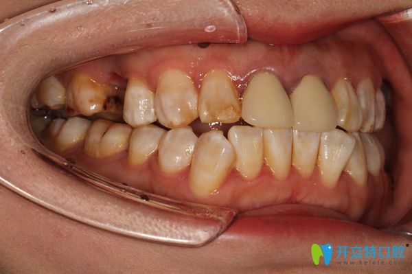 上頜右側牙齒缺失一顆圖示