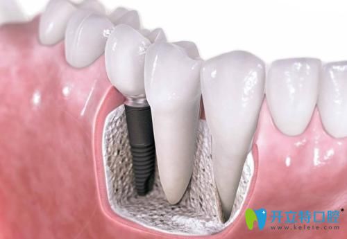 深圳格倫菲爾韓國(guó)系統(tǒng)種植牙