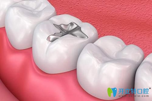 深圳格倫菲爾口腔補(bǔ)牙效果圖