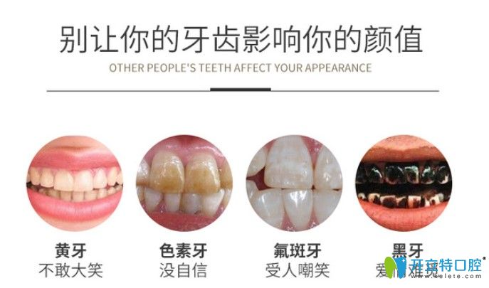 哪些牙齒可以做冷光美白