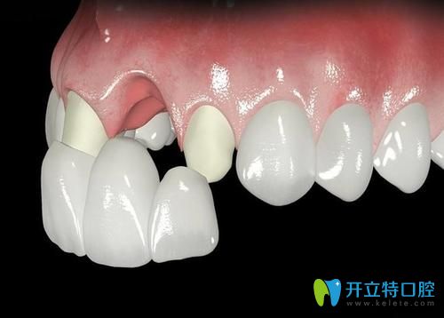 長(zhǎng)沙中諾口腔鈷鉻合金烤瓷牙