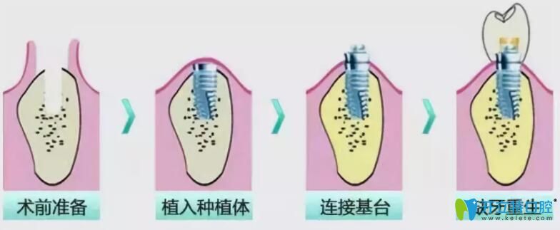 即拔即種和種植牙的區(qū)別,其實是對的時機遇見對的牙齒條件
