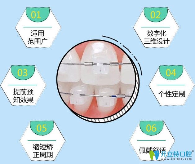 美國(guó)ormco陶瓷自鎖托槽矯正優(yōu)勢(shì)