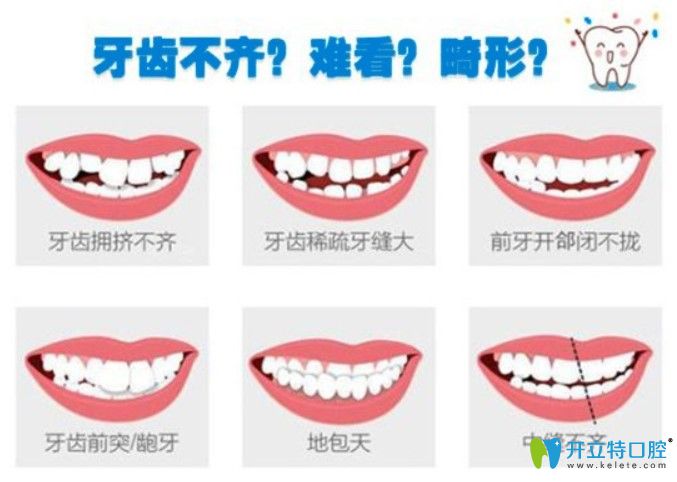 哪些牙齒情況可以做ormco自鎖托槽矯正