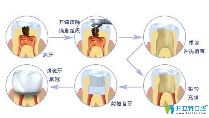 根管治療的過(guò)程