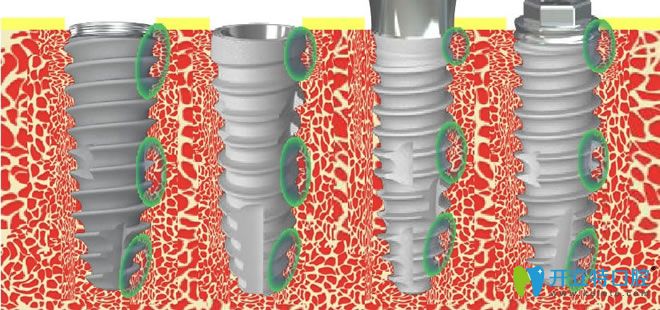 韓國neo種植體缺點