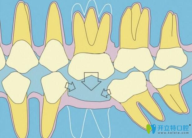 種植牙間隙不夠,正畸關閉或推開間隙來救,注意磨牙慎選
