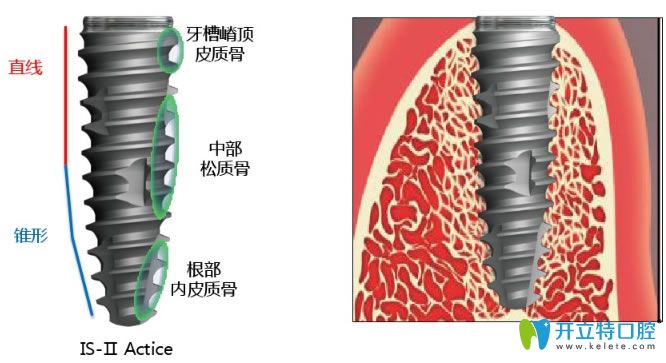 韓國紐百特種植體優(yōu)點