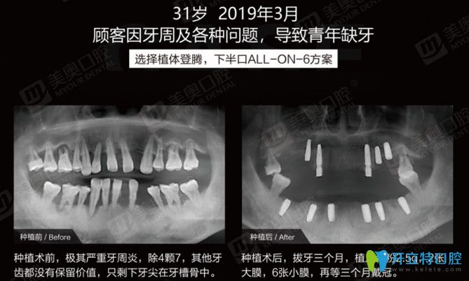 實錘！有案例證實患牙周炎照樣可以做ALL-ON-6半口種植牙