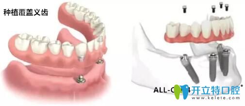種植覆蓋義齒pkALL-ON-4