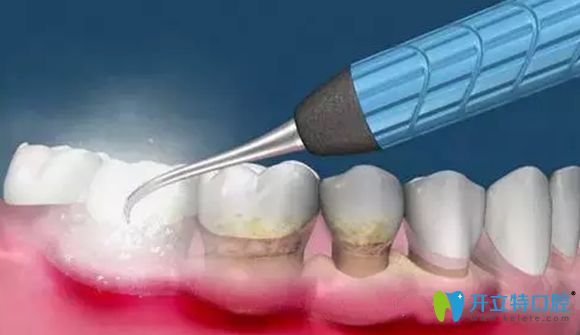 超聲波潔牙是預防和治療輕度牙周炎的方法
