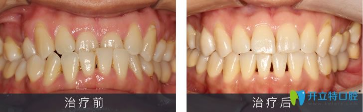 小姐姐個別門牙反頜經(jīng)美國3m自鎖托槽矯正后下巴終于歸位了